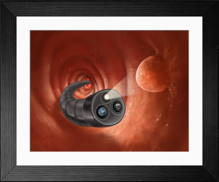 Framed Print : Colonoscopy with Polyps