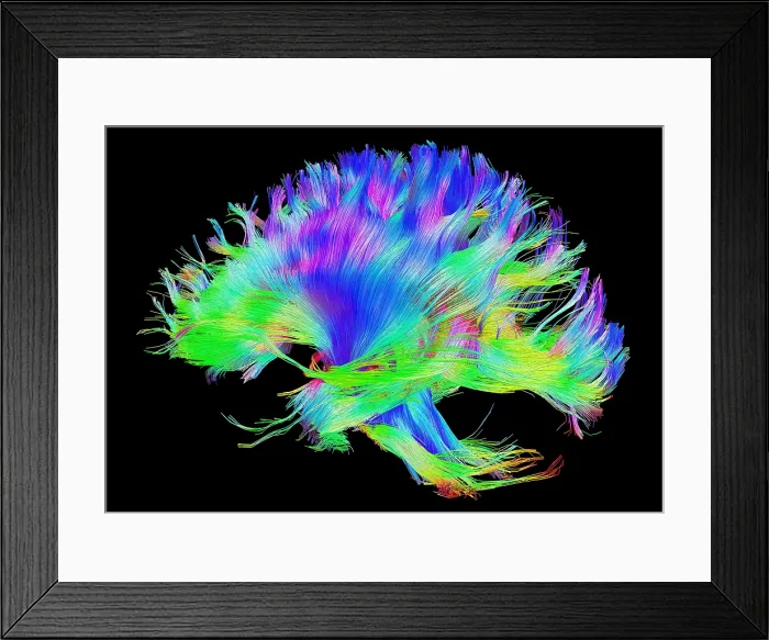 Framed Print : Fiber tracts of the brain, DTI Framed Print : Fiber tracts of the brain, DTI