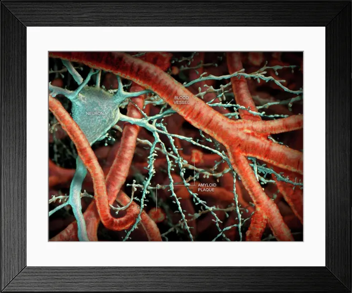 Framed Print : Amyloid Plaque