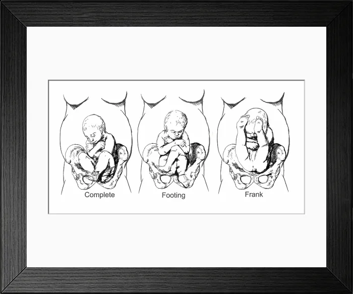 Framed Print : Breech Birth Positions, Illustration