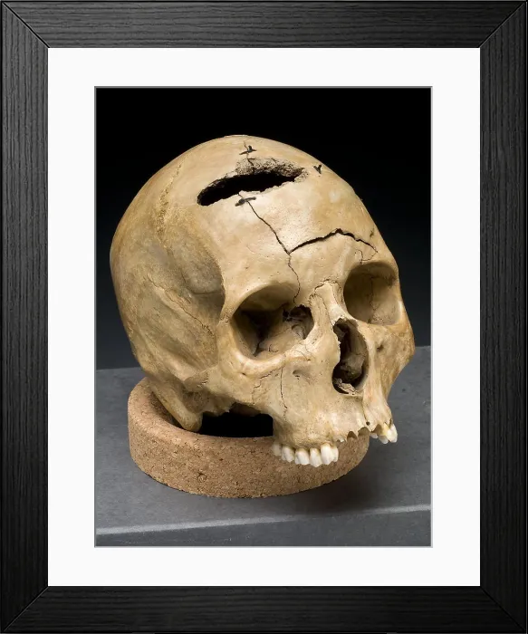 Framed Print : Keyhole Gunshot Trauma, 1860's Framed Print : Keyhole Gunshot Trauma, 1860's