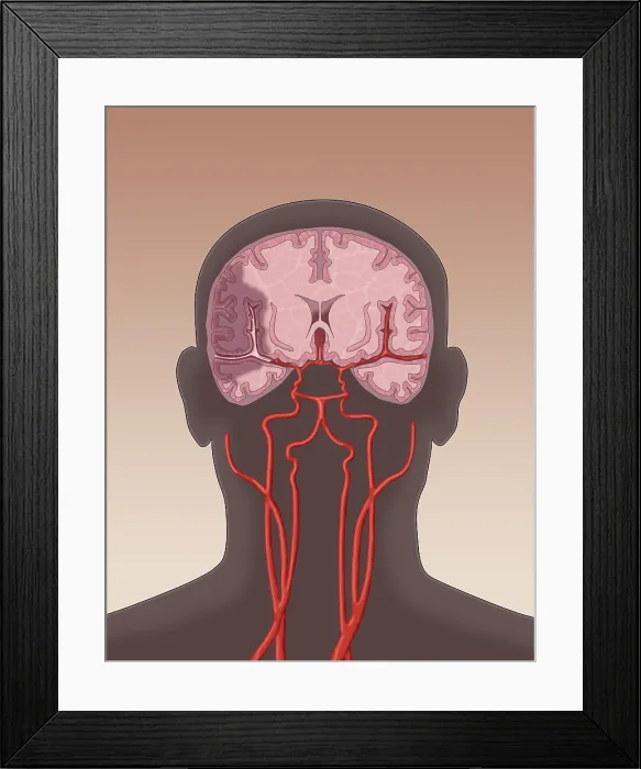 Framed Print : Ischemic Stroke, Illustration Framed Print : Ischemic Stroke, Illustration
