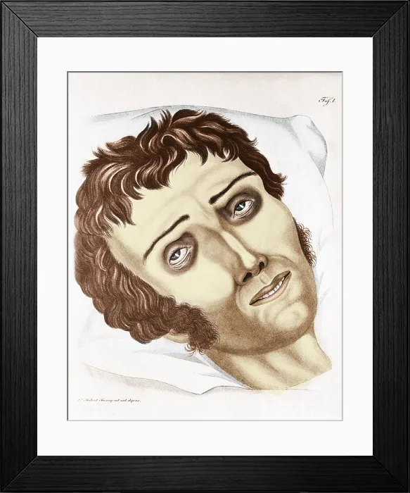 Framed Print : Cholera Victim, 1831