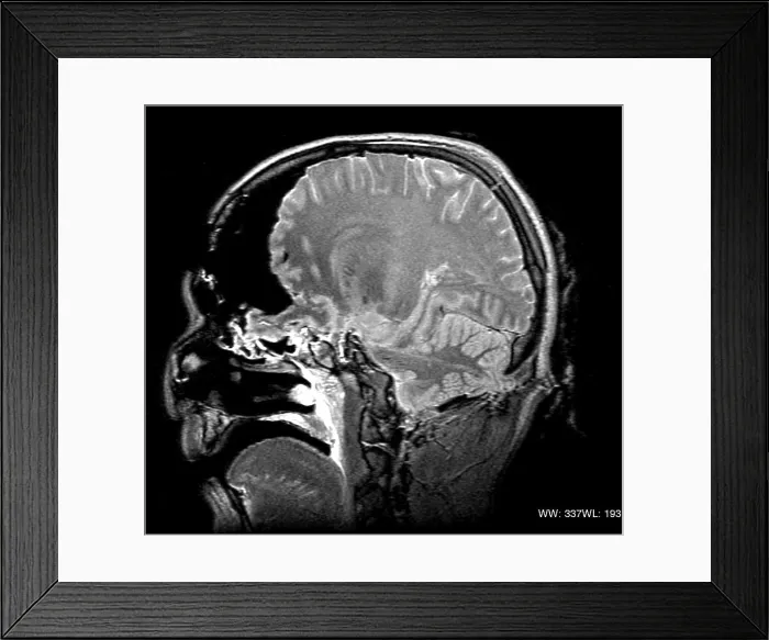 Framed Print : MRI Cross Section, Wound Track