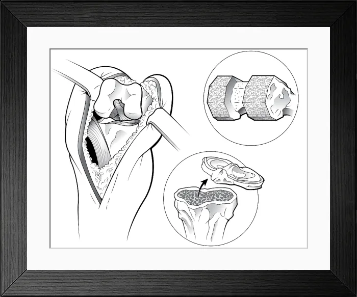 Framed Print : Total Knee Replacement Framed Print : Total Knee Replacement