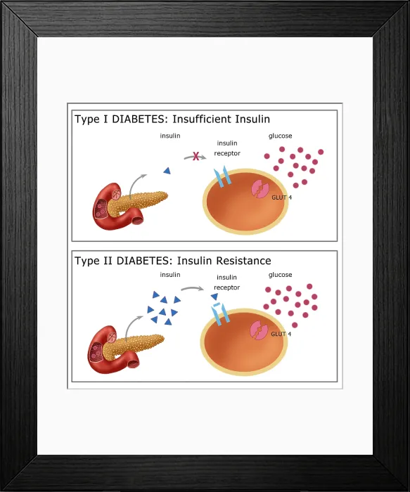 Framed Print : Comparative diagram of type I diabetes and type II diabetes, insulin, glucose, GLUT4 transporter protein, pancreas, medical illustration Framed Print : Comparative diagram of type I diabetes and type II diabetes, insulin, glucose, GLUT4 transporter protein, pancreas, medical illustration