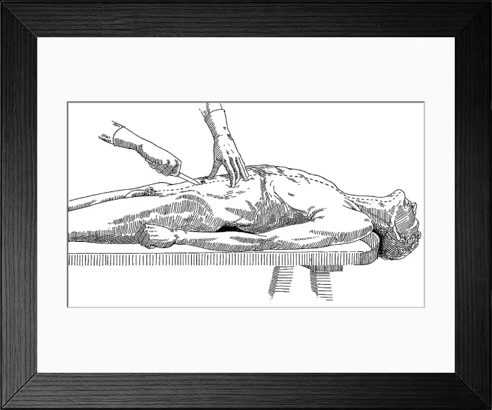 Framed Print : A Handbook of Morbid Anatomy and Post-Mortem Technique