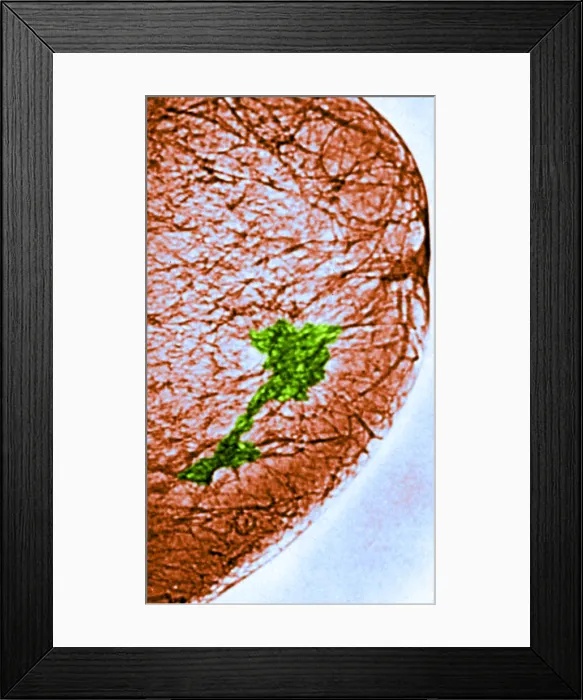 Framed Print : Mammogram. Color enhanced mammogram showing tumors in the breast tissue Framed Print : Mammogram. Color enhanced mammogram showing tumors in the breast tissue