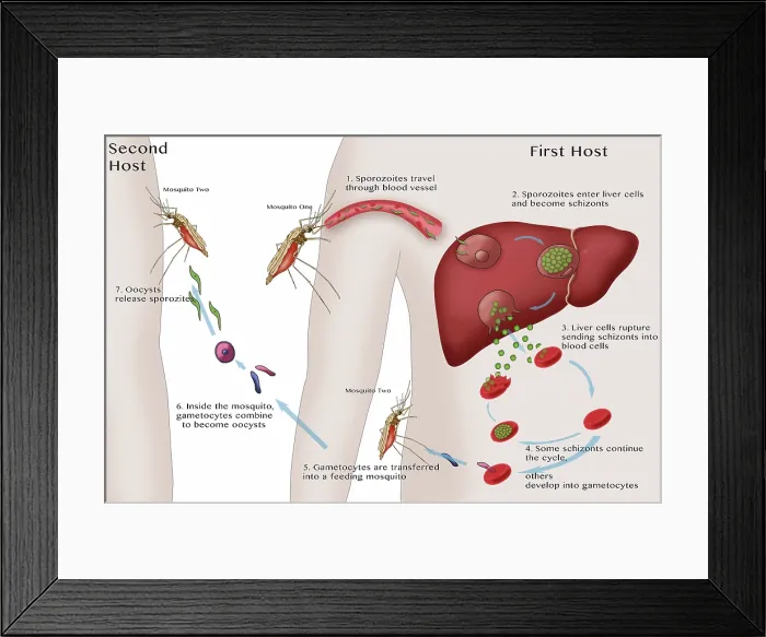 Framed Print : Malaria Cycle diagram showing the liver, blood cells and mosquitos involved, medical Illustration Framed Print : Malaria Cycle diagram showing the liver, blood cells and mosquitos involved, medical Illustration