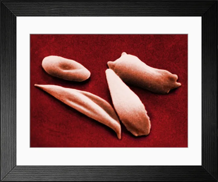 Framed Print : SCD, Sickle-Cell Anemia, under a microscope (SEM) Framed Print : SCD, Sickle-Cell Anemia, under a microscope (SEM)
