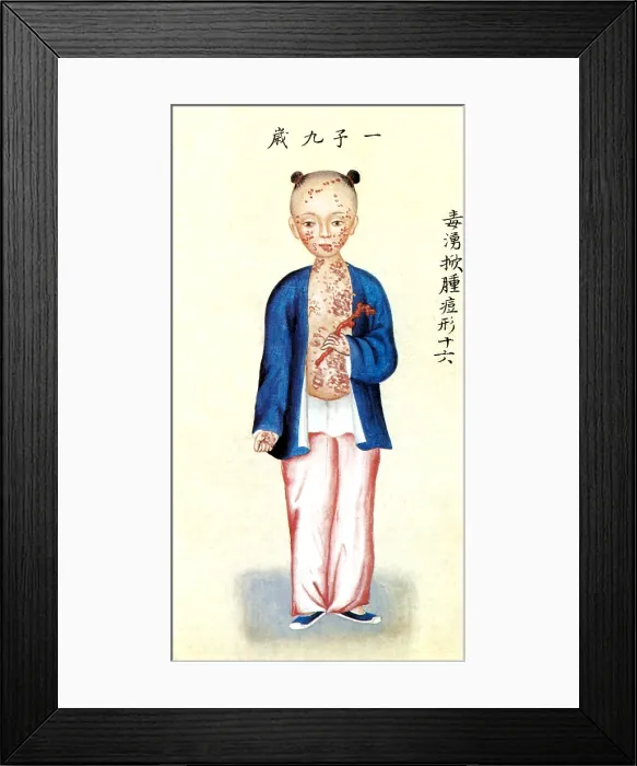 Framed Print : Chinese Smallpox Victim Framed Print : Chinese Smallpox Victim