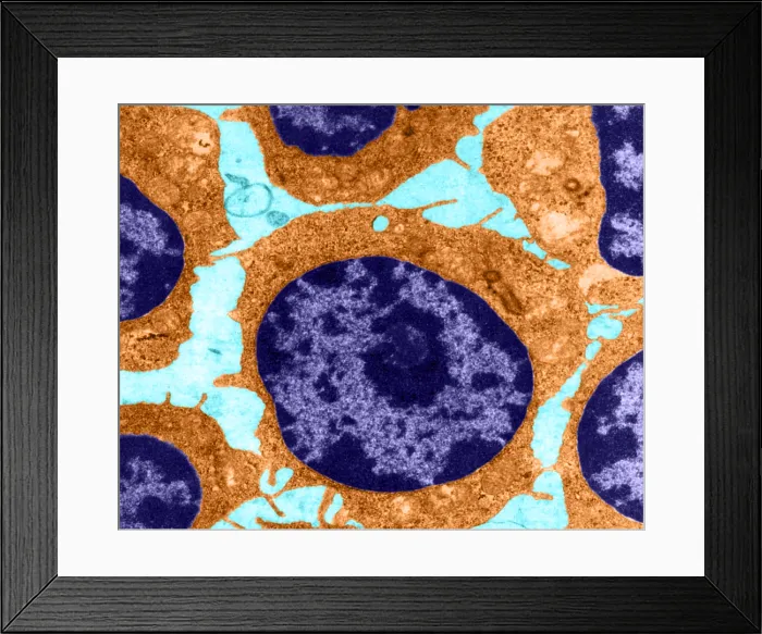 Framed Print : White Blood Cells in Leukemia (TEM) Framed Print : White Blood Cells in Leukemia (TEM)