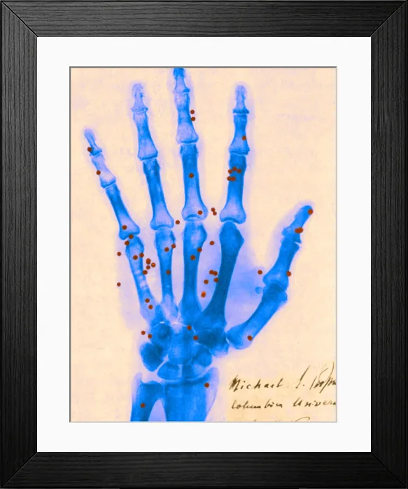 Framed Print : X-ray of Gunshot in the Hand Framed Print : X-ray of Gunshot in the Hand