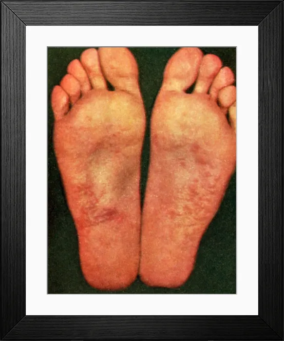 Framed Print : Dyshidrosis Framed Print : Dyshidrosis