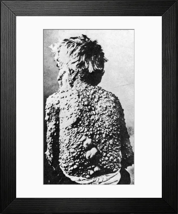 Framed Print : Neurofibromatosis