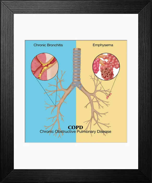 Framed Print : Chronic Obstructive Pulmonary Disease (COPD)