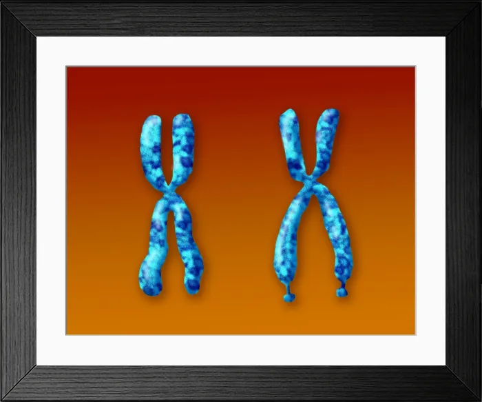 Framed Print : Fragile X Syndrome (FXS) is a genetic condition often associated with autism spectrum disorder (ASD), illustration