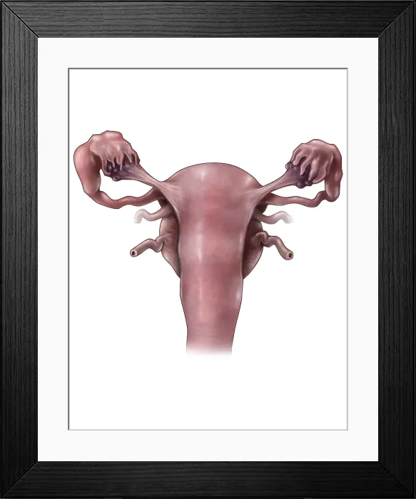 Framed Print : Uterus, Ovaries and Bladder (Posterior View) Framed Print : Uterus, Ovaries and Bladder (Posterior View)