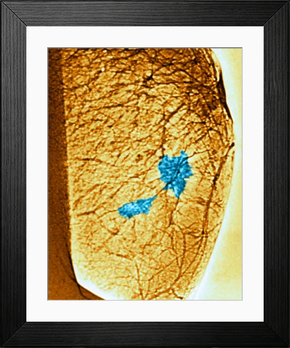 Framed Print : Mammogram. Color enhanced mammogram showing tumors in the breast tissue Framed Print : Mammogram. Color enhanced mammogram showing tumors in the breast tissue