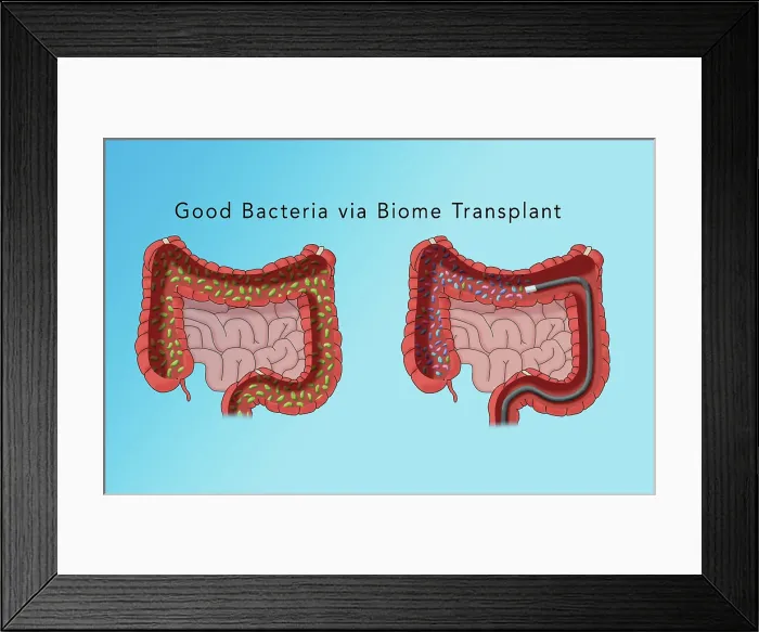 Framed Print : The microbiome of the large intestine, comparison of good and bad bacteria, medical illustration Framed Print : The microbiome of the large intestine, comparison of good and bad bacteria, medical illustration