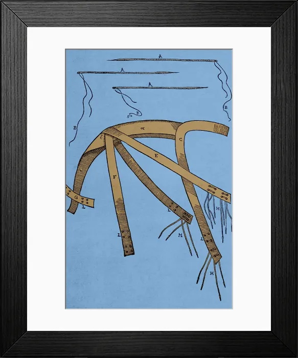 Framed Print : Tagliacozzi Rhinoplasty Method Equipment
