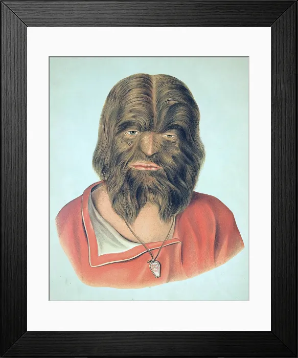 Framed Print : Hypertrichosis, 19th Century Framed Print : Hypertrichosis, 19th Century