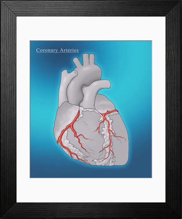 Framed Print : Coronary Arteries, Illustration Framed Print : Coronary Arteries, Illustration