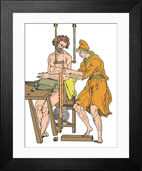 Framed Print : Roman Devices for Setting Fractures Framed Print : Roman Devices for Setting Fractures