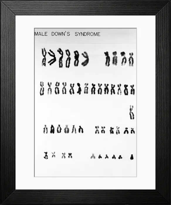 Framed Print : Karyotype, Down Syndrome