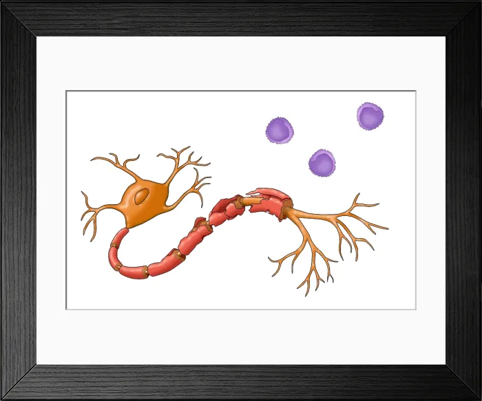 Framed Print : Multiple Sclerosis Framed Print : Multiple Sclerosis