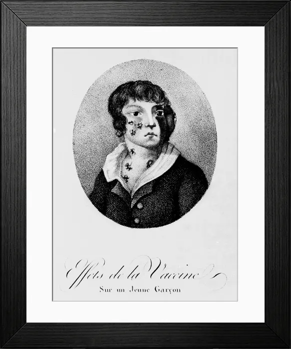 Framed Print : Development of Smallpox after Vaccination, 1807 Framed Print : Development of Smallpox after Vaccination, 1807