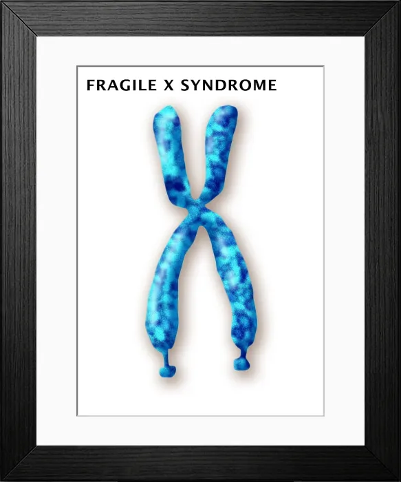 Framed Print : Fragile X Syndrome (FXS) is a genetic condition often associated with autism spectrum disorder (ASD), illustration Framed Print : Fragile X Syndrome (FXS) is a genetic condition often associated with autism spectrum disorder (ASD), illustration