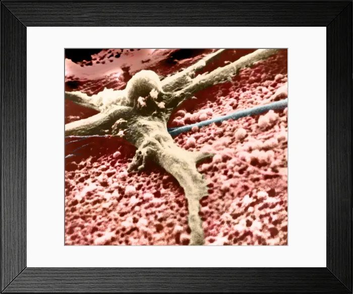 Framed Print : Malignant cancer cell Framed Print : Malignant cancer cell