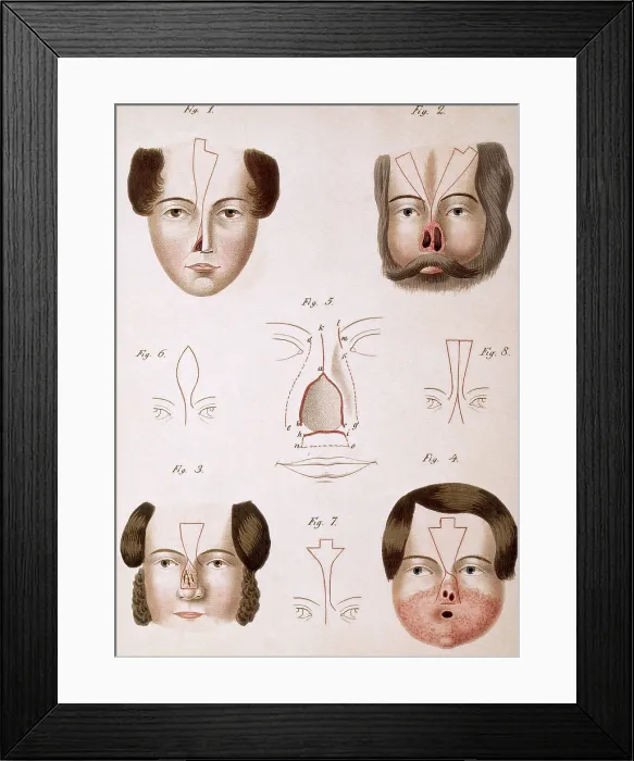 Framed Print : Nose Reconstruction, 1815 Medical Text