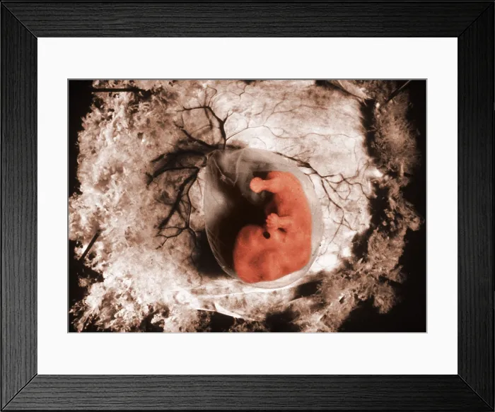 Framed Print : Human Embryo, gross specimen Framed Print : Human Embryo, gross specimen