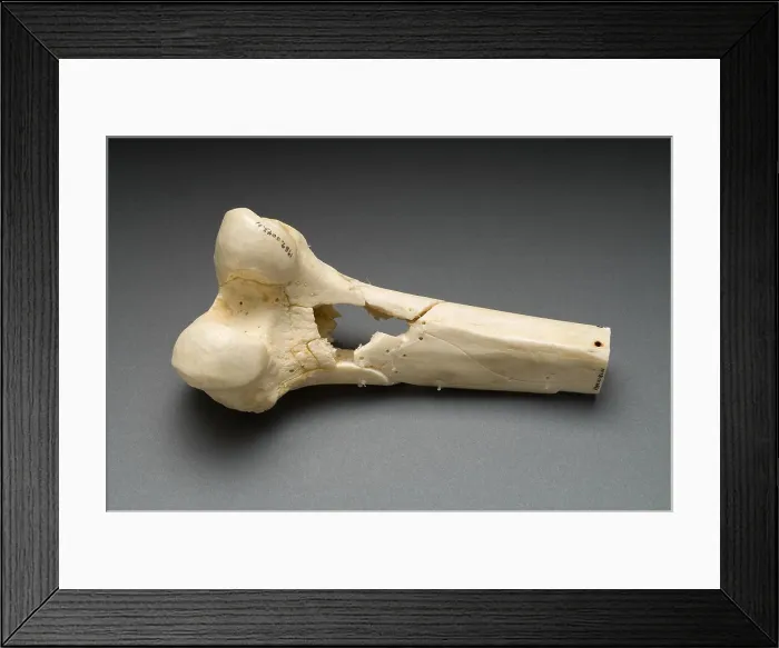Framed Print : Human Distal Femur, Gunshot Wound, 1984 Framed Print : Human Distal Femur, Gunshot Wound, 1984