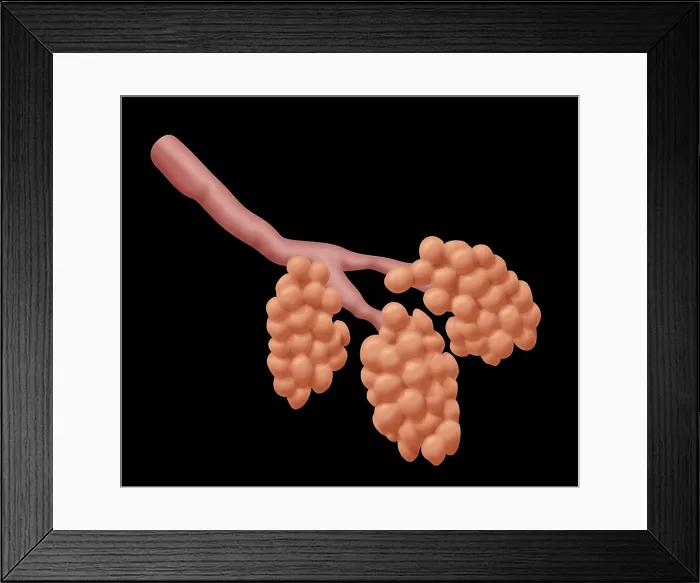 Framed Print : Damaged Alveoli