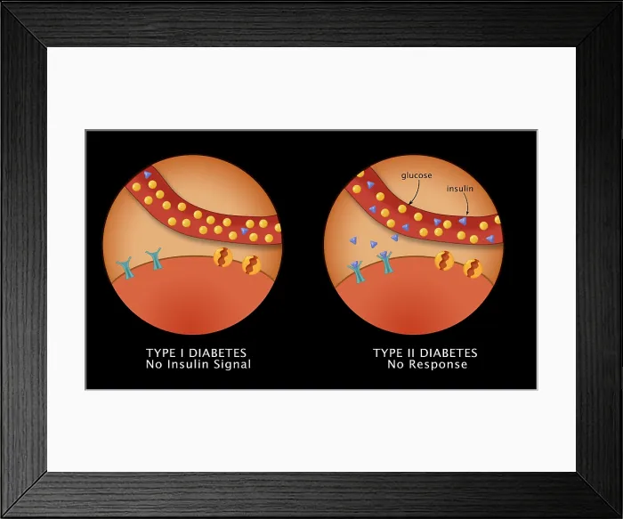 Framed Print : Comparative diagram of type I diabetes and type II diabetes, insulin, glucose, GLUT4 transporter protein, pancreas, medical illustration Framed Print : Comparative diagram of type I diabetes and type II diabetes, insulin, glucose, GLUT4 transporter protein, pancreas, medical illustration