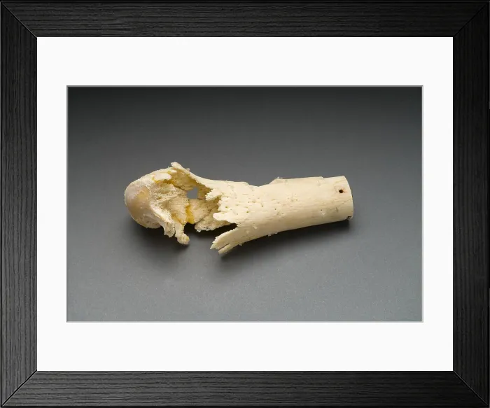 Framed Print : Human Distal Femur, Gunshot Wound, 1984 Framed Print : Human Distal Femur, Gunshot Wound, 1984