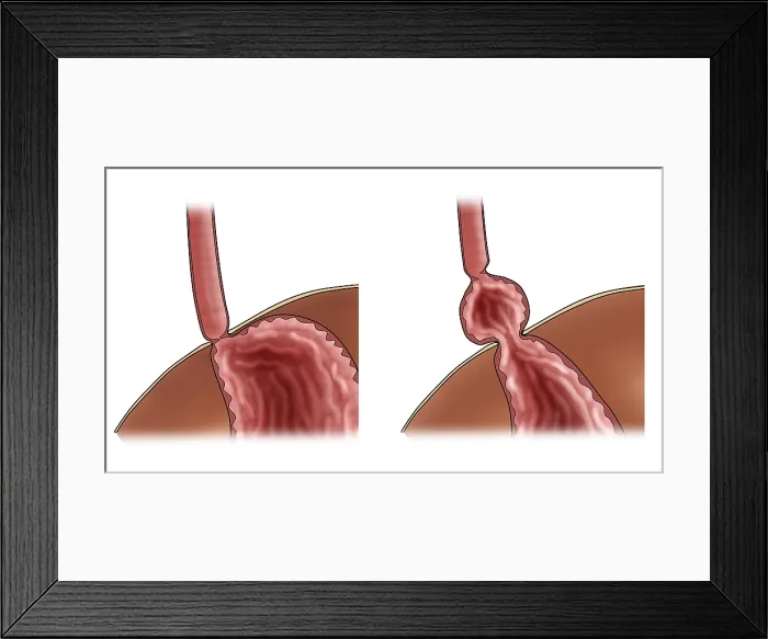 Framed Print : Normal Stomach & Stomach with Hiatal Hernia Framed Print : Normal Stomach & Stomach with Hiatal Hernia