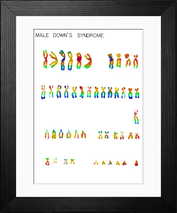 Framed Print : Karyotype, Down Syndrome Framed Print : Karyotype, Down Syndrome