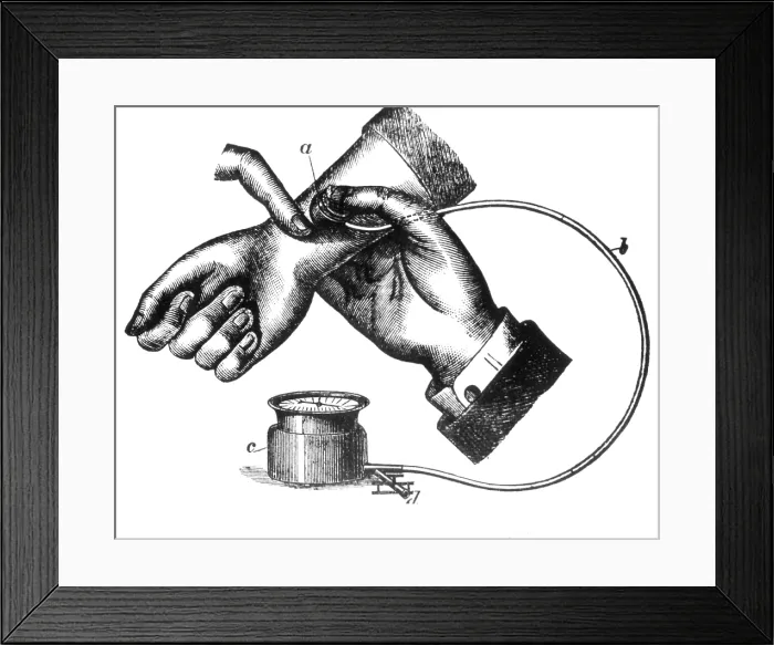 Framed Print : Sphygmomanometer, 1883 Framed Print : Sphygmomanometer, 1883