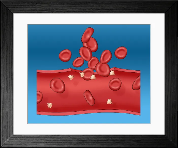 Framed Print : Blood clot