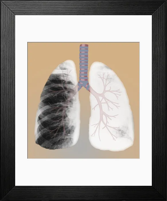 Framed Print : Bronchus Cancer Framed Print : Bronchus Cancer