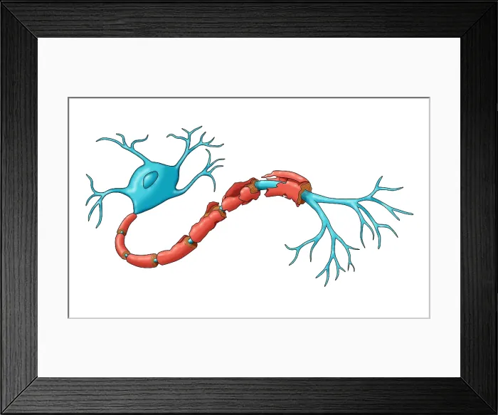 Framed Print : Demyelination Framed Print : Demyelination