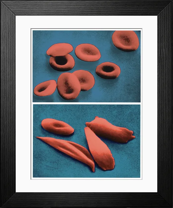 Framed Print : Normal RBCs and Sickle-Cell Anemia, under a microscope (SEM) Framed Print : Normal RBCs and Sickle-Cell Anemia, under a microscope (SEM)