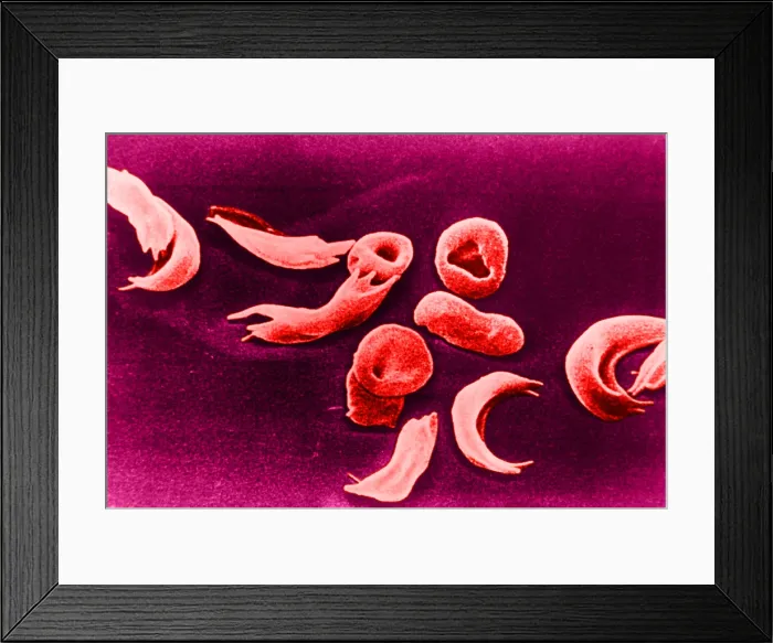 Framed Print : SCD, Sickle-Cell Anemia, under a microscope (SEM) Framed Print : SCD, Sickle-Cell Anemia, under a microscope (SEM)