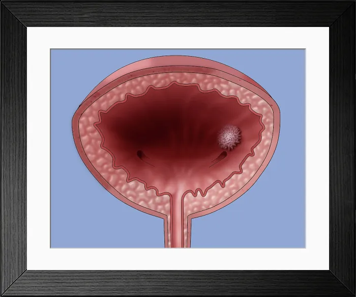 Framed Print : Bladder Cancer, Illustration Framed Print : Bladder Cancer, Illustration