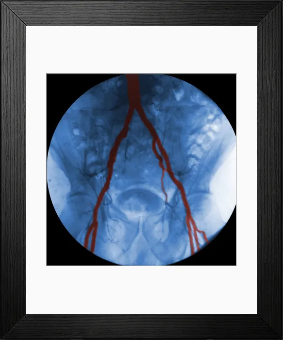 Framed Print : Angiogram of Iliac Arteries