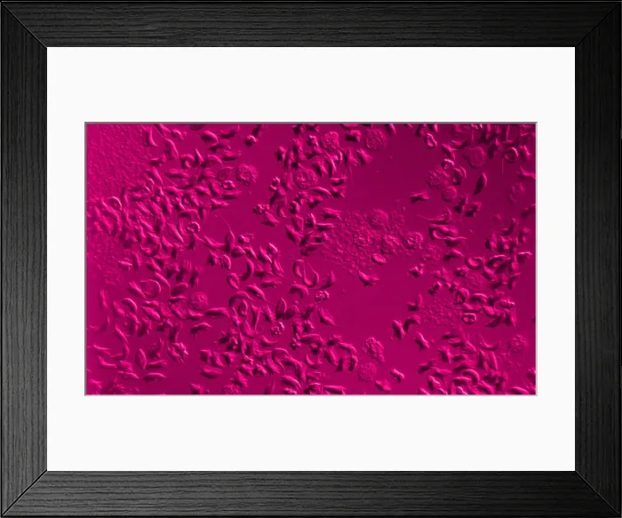 Framed Print : SCD, Sickle-Cell Anemia, light micrograph Framed Print : SCD, Sickle-Cell Anemia, light micrograph